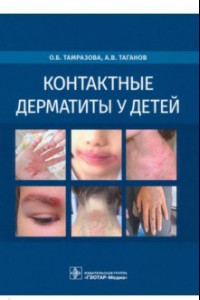 Книга Контактные дерматиты у детей