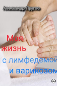 Моя жизнь с лимфедемой и варикозом